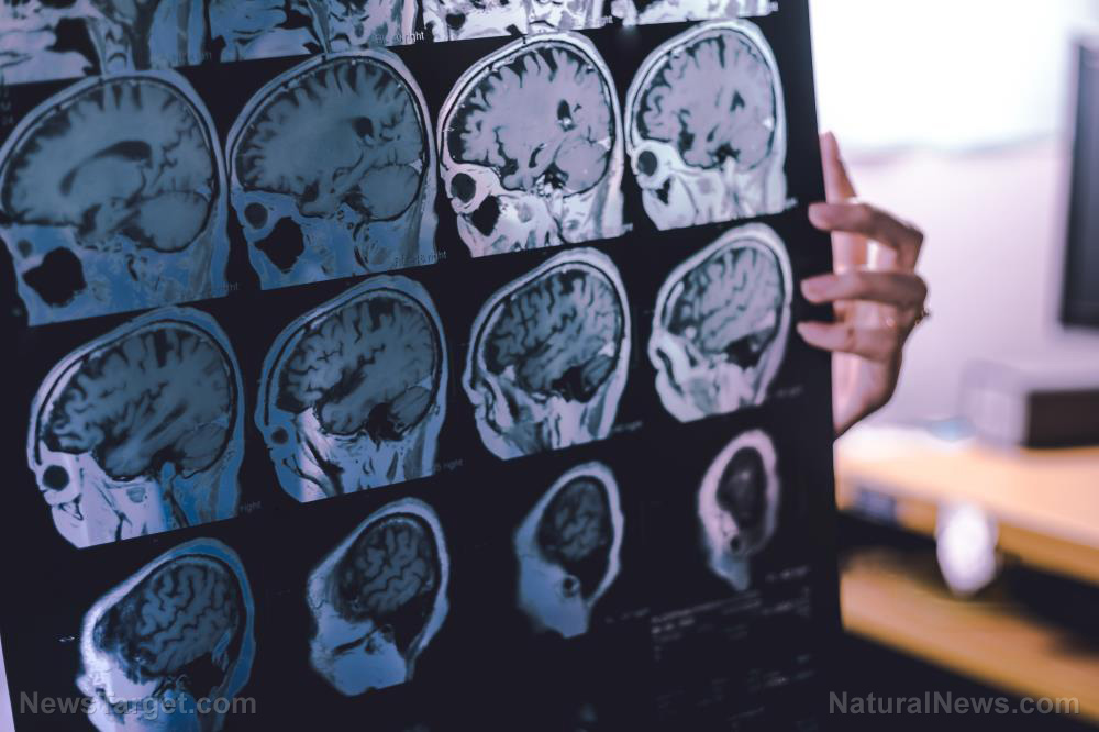 Image: STUDY: Covid vaccines cause Alzheimer’s, brain changes