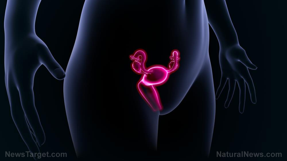 PCOS is a sign of hormonal imbalance, and if left untreated, exacerbates other chronic health diseases – NaturalNews.com