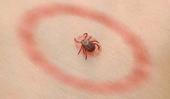 Lyme disease’s staggering financial toll exposed in new study – NaturalNews.com
